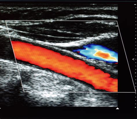 mobile intimal media thickness testing|carotid intima media thickness.